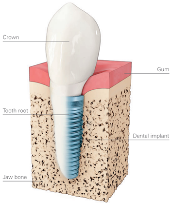 Dental Implant Diagram Dental Implant Diagram