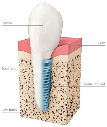 Dental Implant Diagram