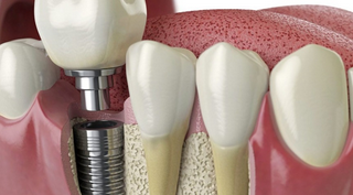 Dental Implants