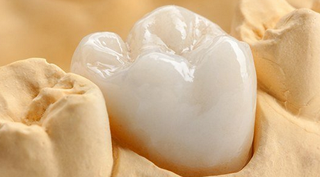 metal-free-restorations-pic