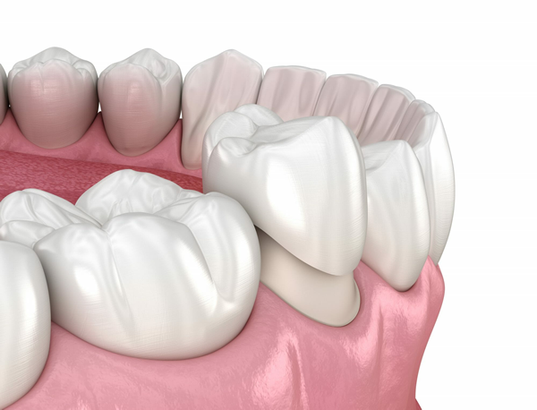 Dental Crown Dental Crown