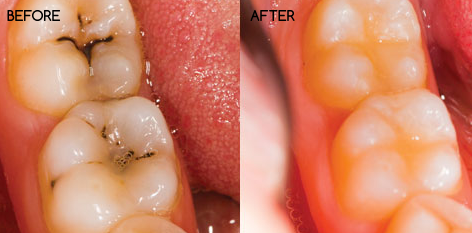 Dental Filling Dental Filling