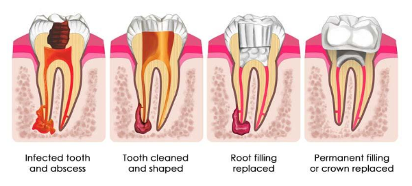 rootcanal