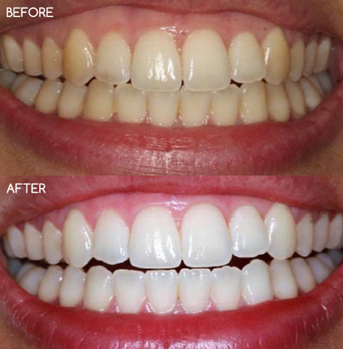 Teeth Whitening Teeth Whitening