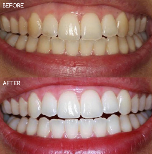 Teeth Whitening