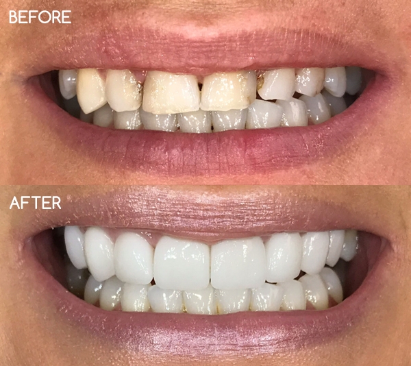 Dental Veneers Dental Veneers