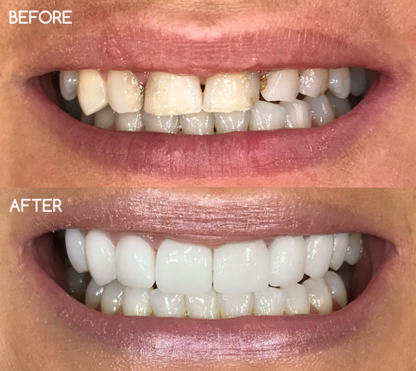 Dental Veneers